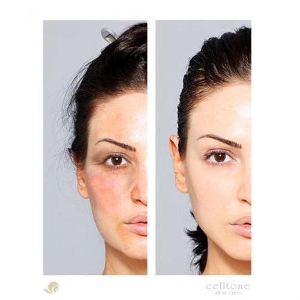 celltone before after4